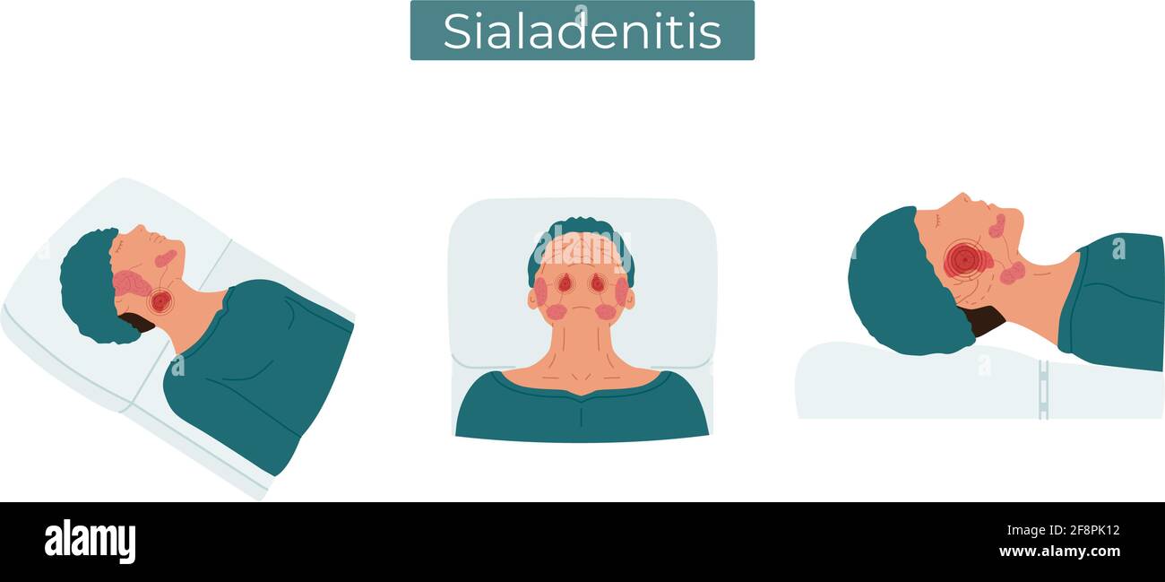 Immagine piatta vettoriale della sialadenite. Una persona con ghiandole salivari infiammate. Il paziente avverte dolore nelle ghiandole salivari. Illustrazione Vettoriale