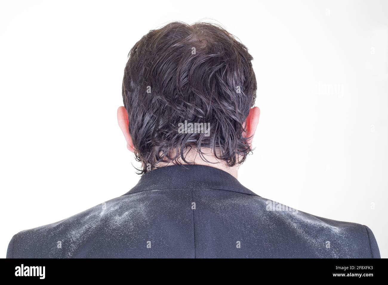 Uomo con forfora - dermatite seborrheic Foto Stock