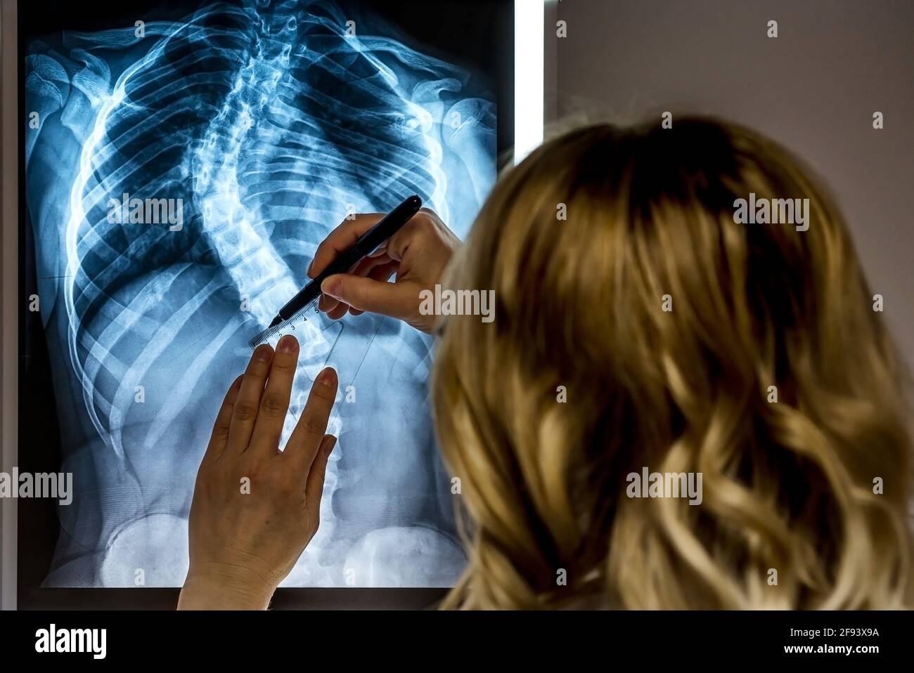 Bionda medico femminile che guarda un paziente radiografia. Specialista di scoliosi medico effettuare misurazioni ai raggi X dei pazienti Foto Stock