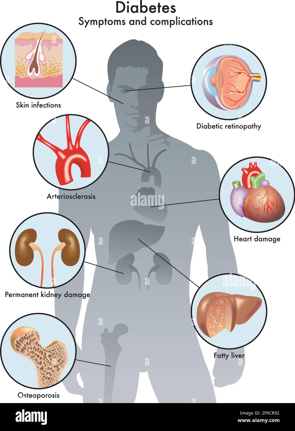 Illustrazione medica dei sintomi e delle complicazioni del diabete. Illustrazione Vettoriale