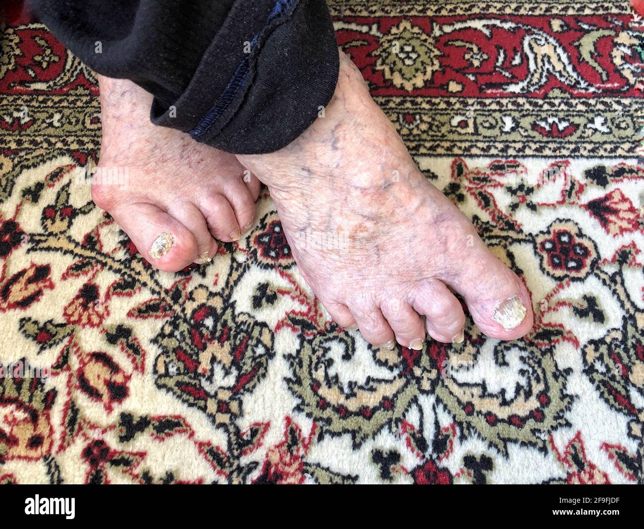 primo piano dei piedi con artrite, unghie danneggiate a causa del fungo e piede dell'atleta Foto Stock