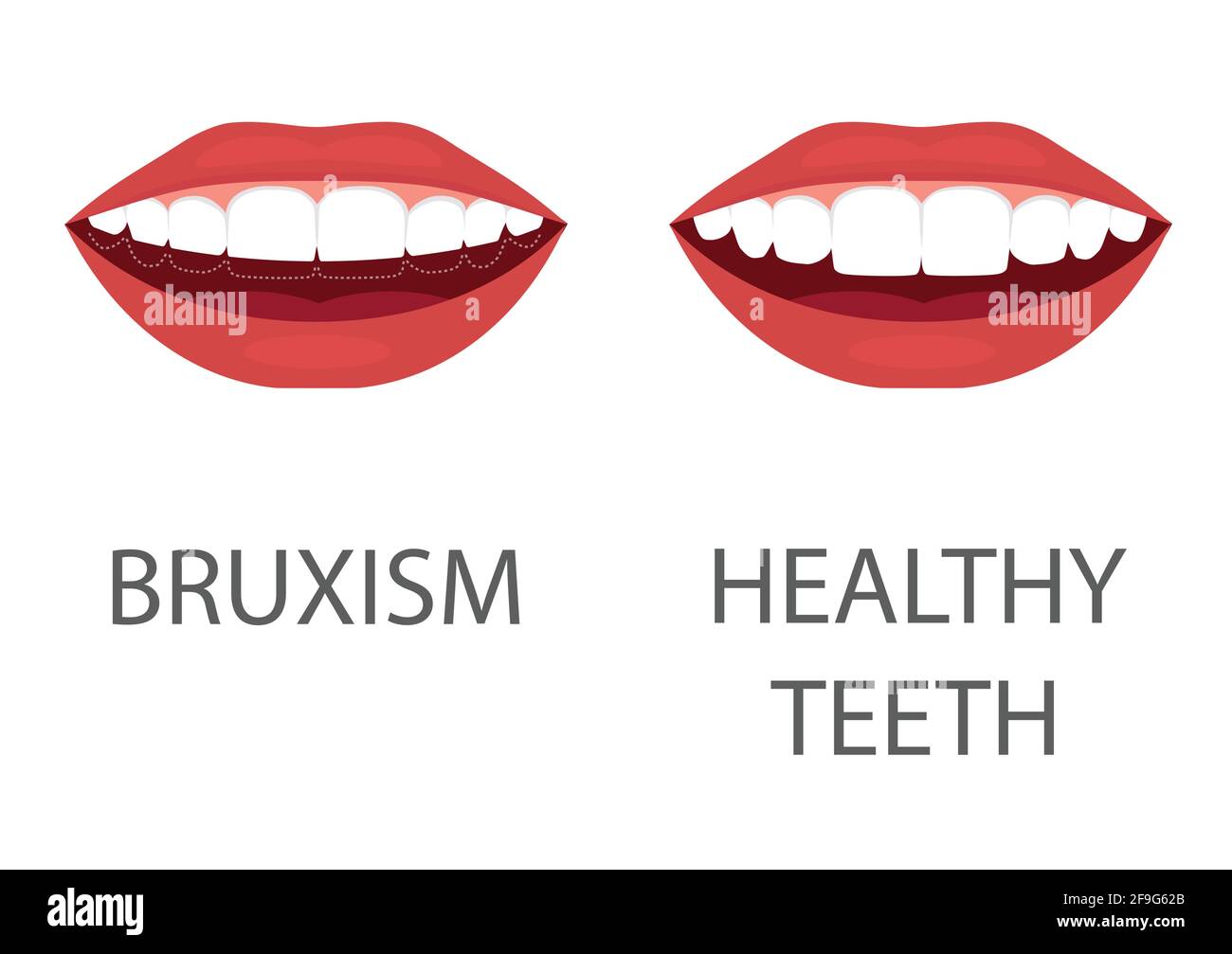 illustrazione vettoriale del bruxismo. molatura dei denti. dentista apparecchio. cura dentale. odontoiatria problema di salute Illustrazione Vettoriale