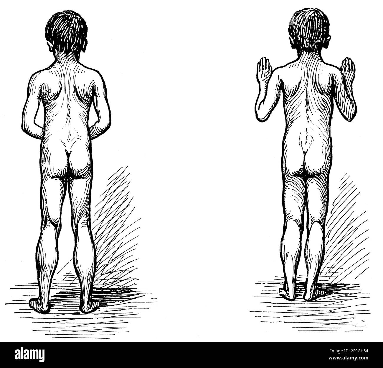 Bambino paralizzato su tutti e quattro gli arti. Illustrazione del 19 ° secolo. Germania. Sfondo bianco. Foto Stock