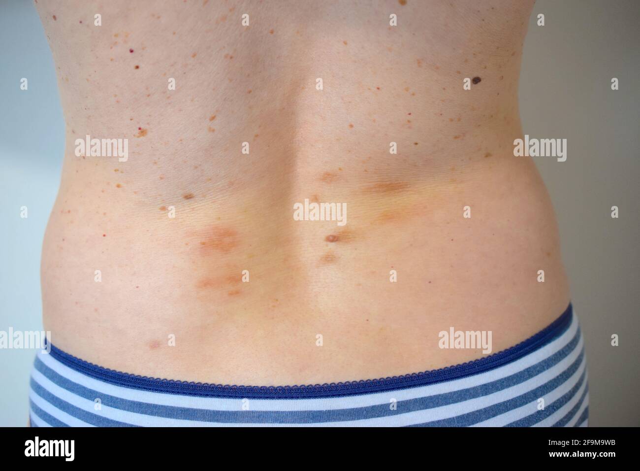 Talpe e macchie scure sulla pelle della schiena femminile Foto stock - Alamy