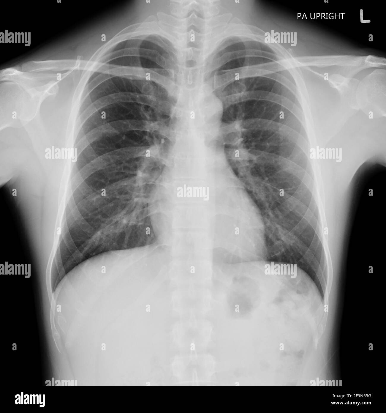 Pellicola radiografica del torace maschio normale Foto Stock