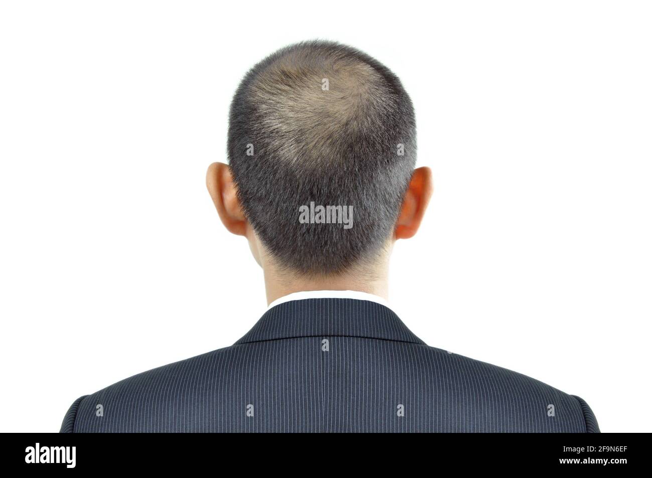 Sintomo di assottigliamento dei capelli sulla testa di un uomo - segno di perdita di capelli Foto Stock
