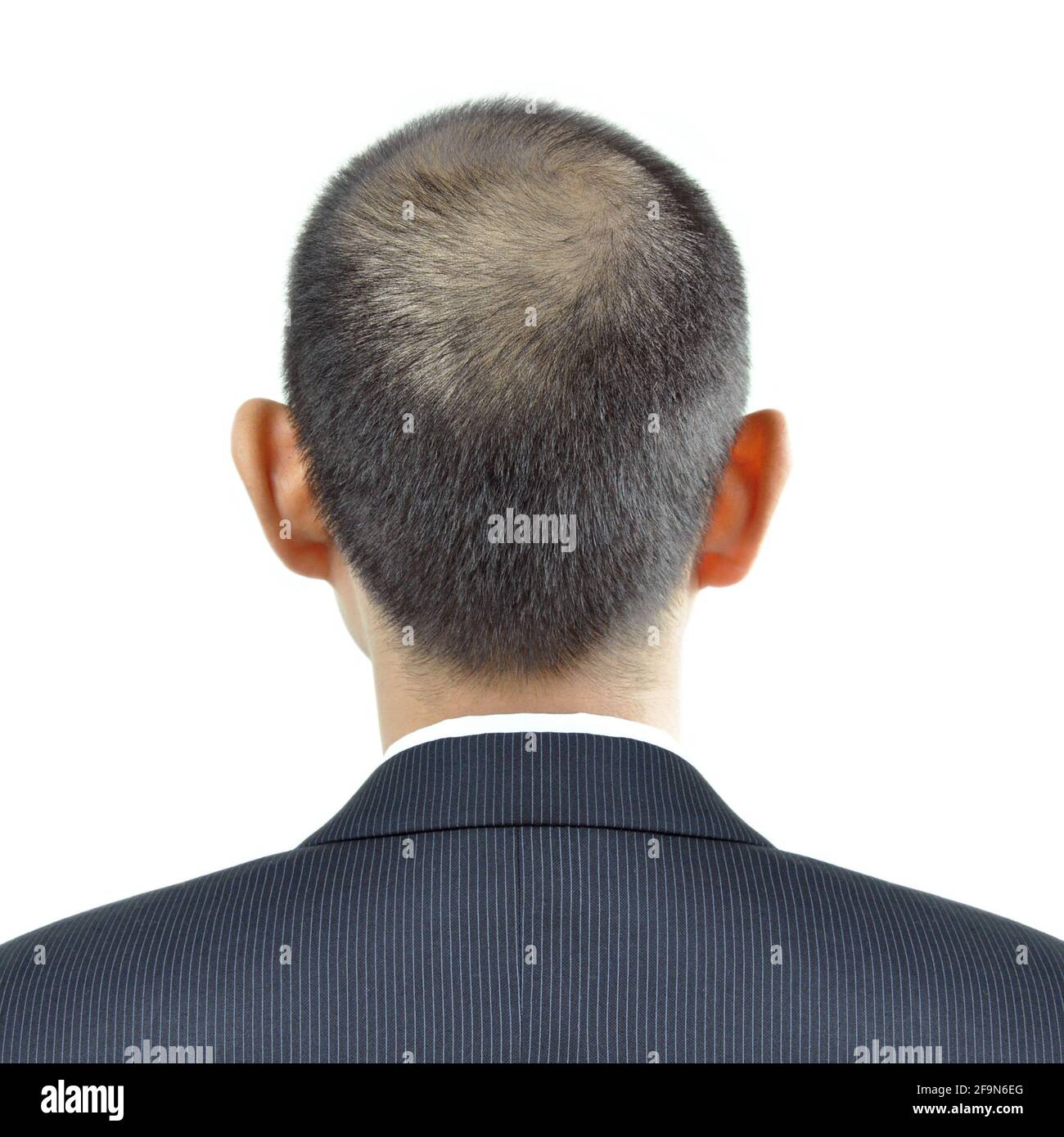 Sintomo di assottigliamento dei capelli sulla testa di un uomo - segno di perdita di capelli Foto Stock