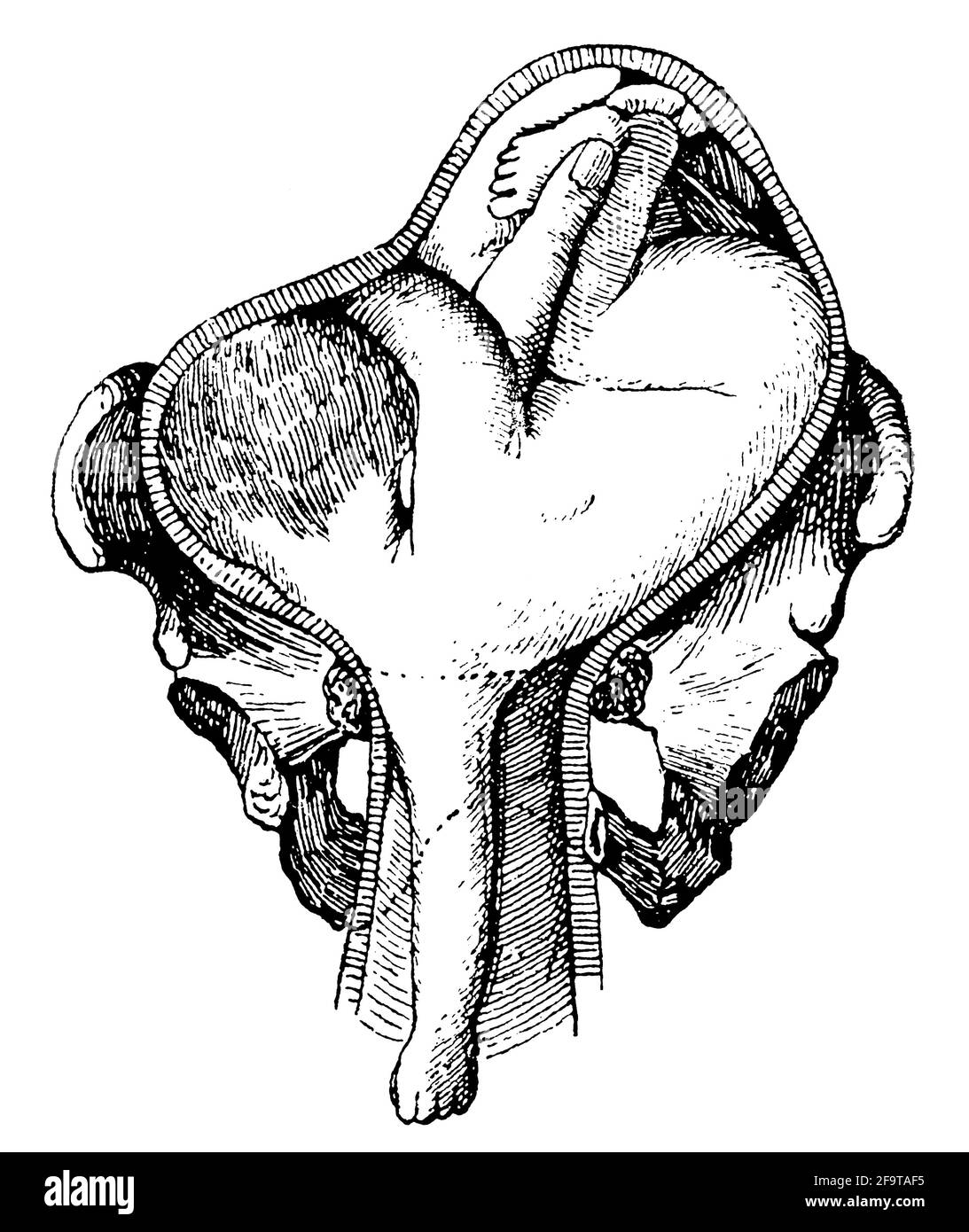 Ostetricia in patologia. Presentazione delle spalle. Illustrazione del 19 ° secolo. Germania. Sfondo bianco. Foto Stock