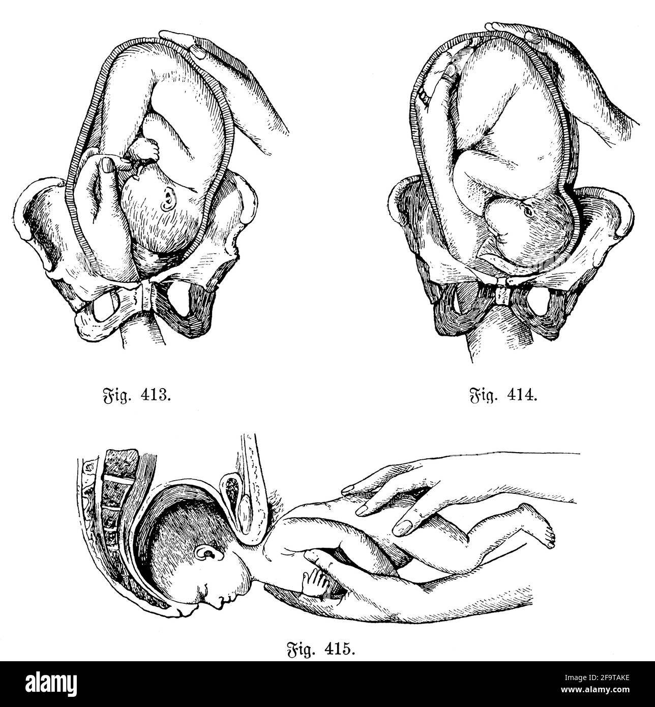 Ostetricia. Parto. Illustrazione del 19 ° secolo. Germania. Sfondo bianco. Foto Stock