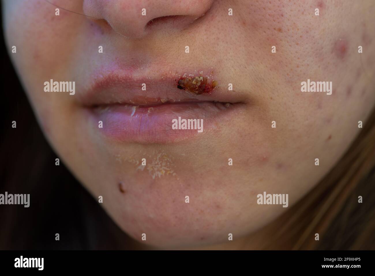 primo piano di giovane donna con vera e propria herpes labiale e. pelle secca e difettosa Foto Stock