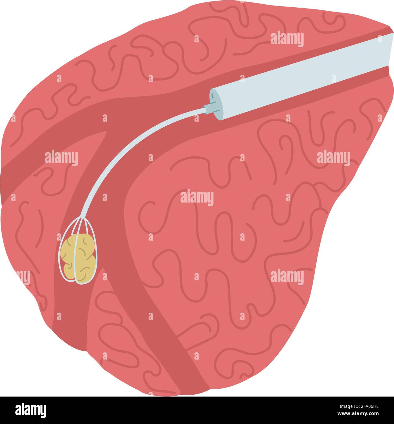 Illustrazione vettoriale della chirurgia endoscopica per rimuovere una pietra dalla ghiandola salivare. Sialendoscopia Illustrazione Vettoriale