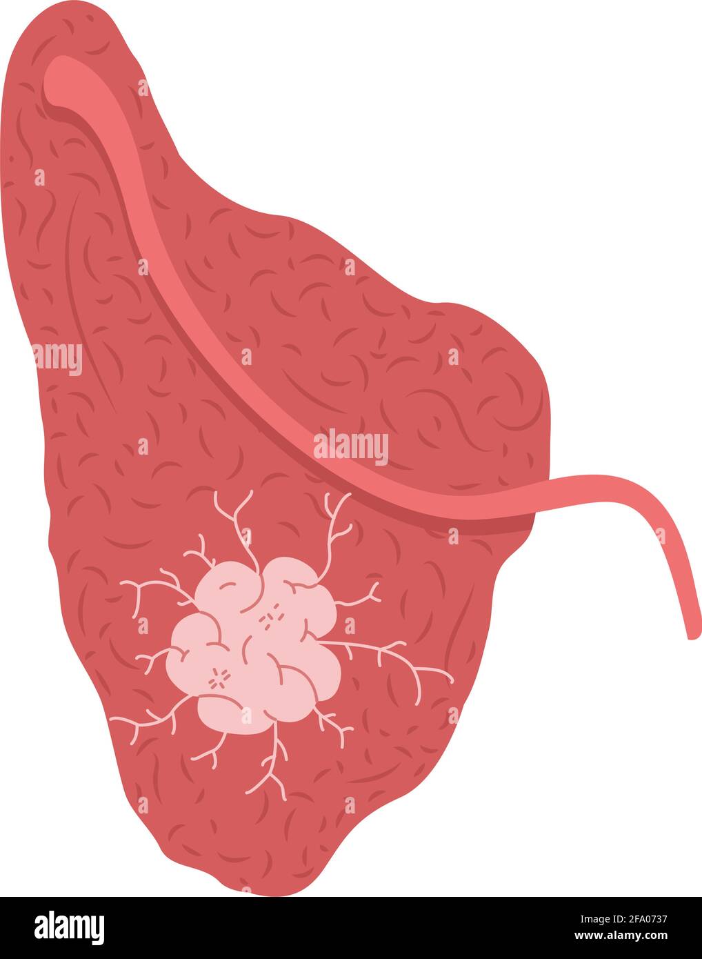 Un tumore sulla ghiandola salivare parotide. Illustrazione del vettore medico. Illustrazione Vettoriale