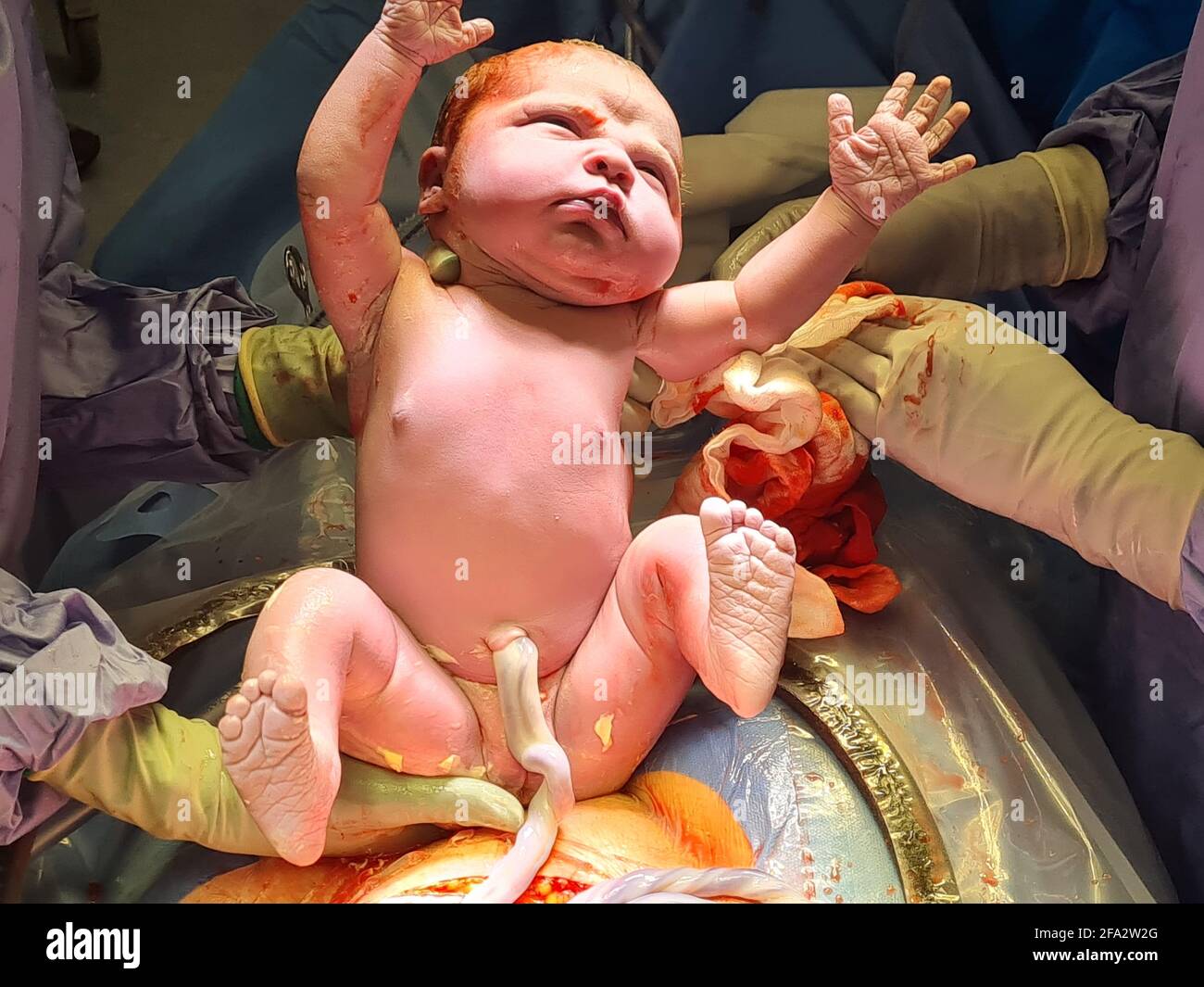 AUCKLAND, NUOVA ZELANDA - 13 aprile 2021: Una bambina neonato illuminata da luci chirurgiche ha le mani in su, e gli occhi aperti come è appena stata tirata f Foto Stock
