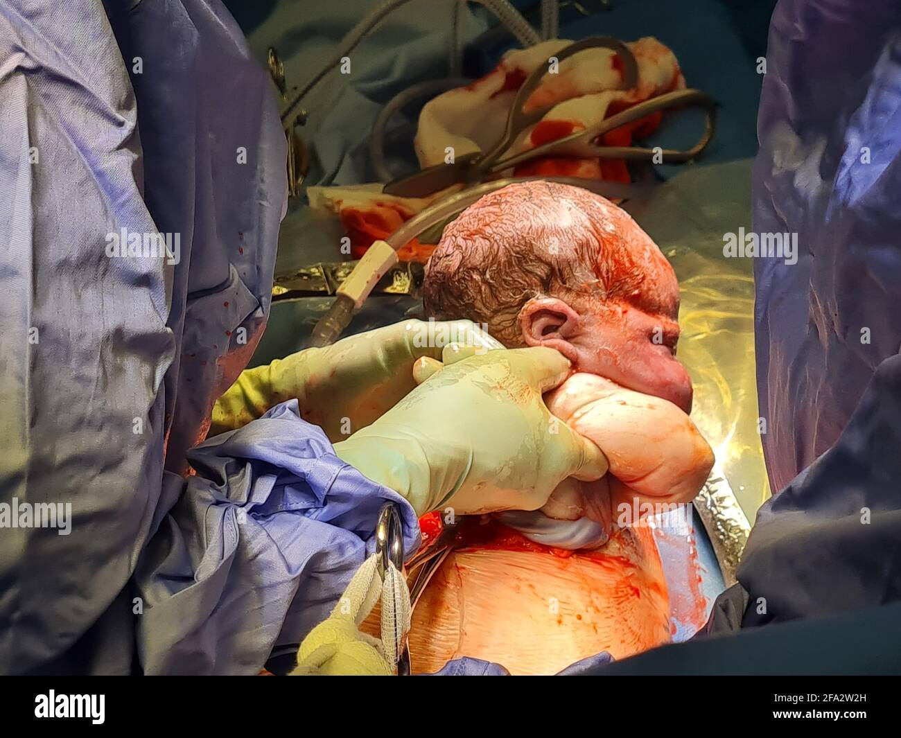 AUCKLAND, NUOVA ZELANDA - Apr 13, 2021: Ostetrico tira il bambino di termine neonato dalla ferita cesarean. Le mani dei chirurghi sono alle spalle del bambino che tira verso l'alto Foto Stock