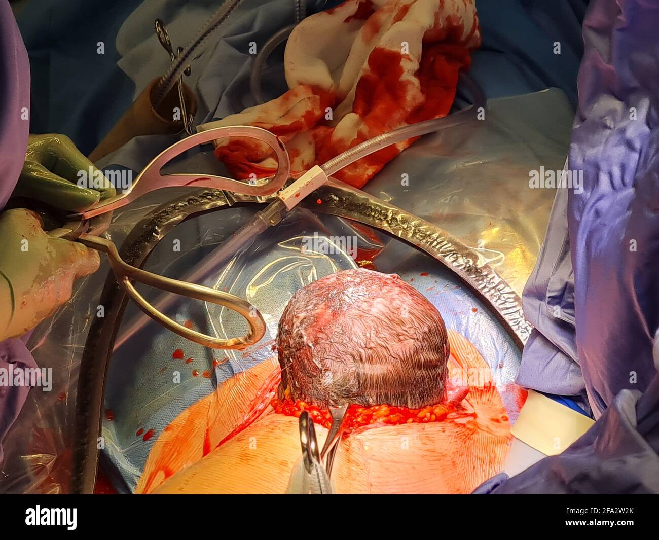 AUCKLAND, NUOVA ZELANDA - 13 aprile 2021: Foto della testa di un bambino che sporge a metà strada, passando attraverso la ferita LCSC, chirurgo e forcipe visto a sinistra, surgica Foto Stock