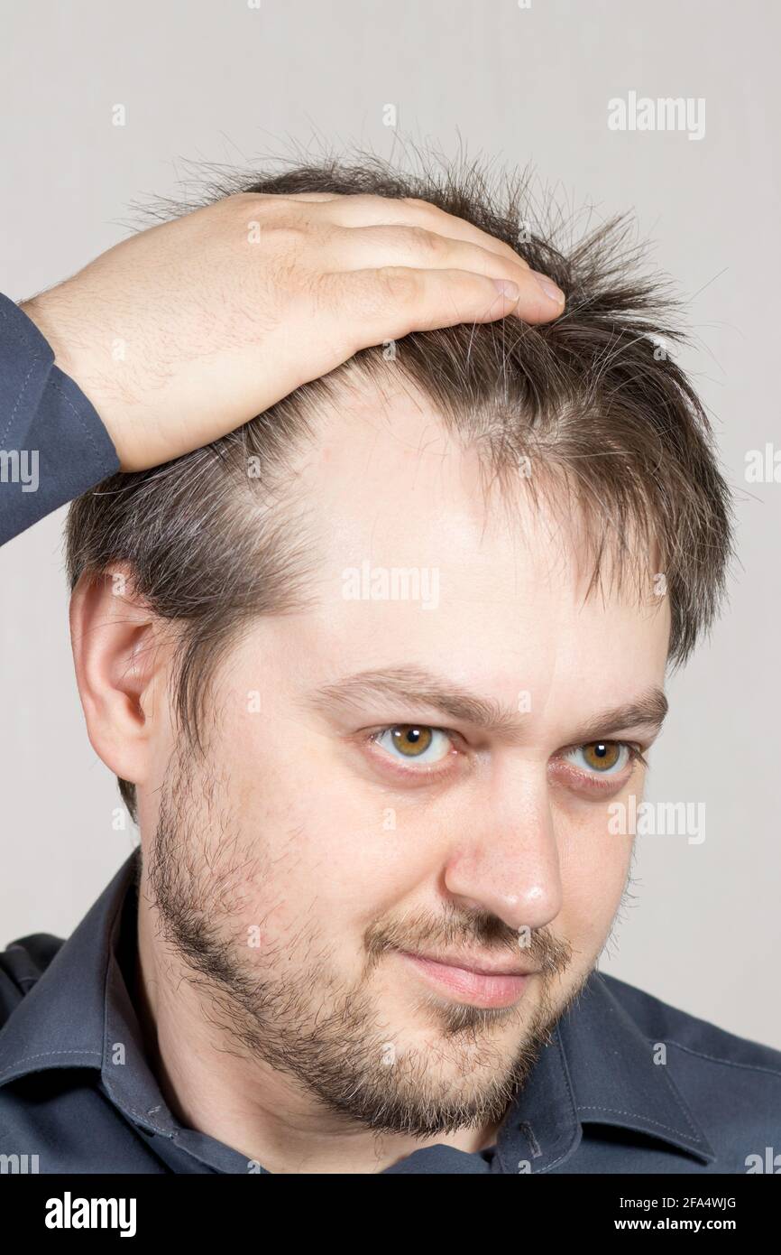 L'uomo mostra una fronte alta con la linea di capelli recedendo. Calvizie  negli uomini, cura dei capelli Foto stock - Alamy