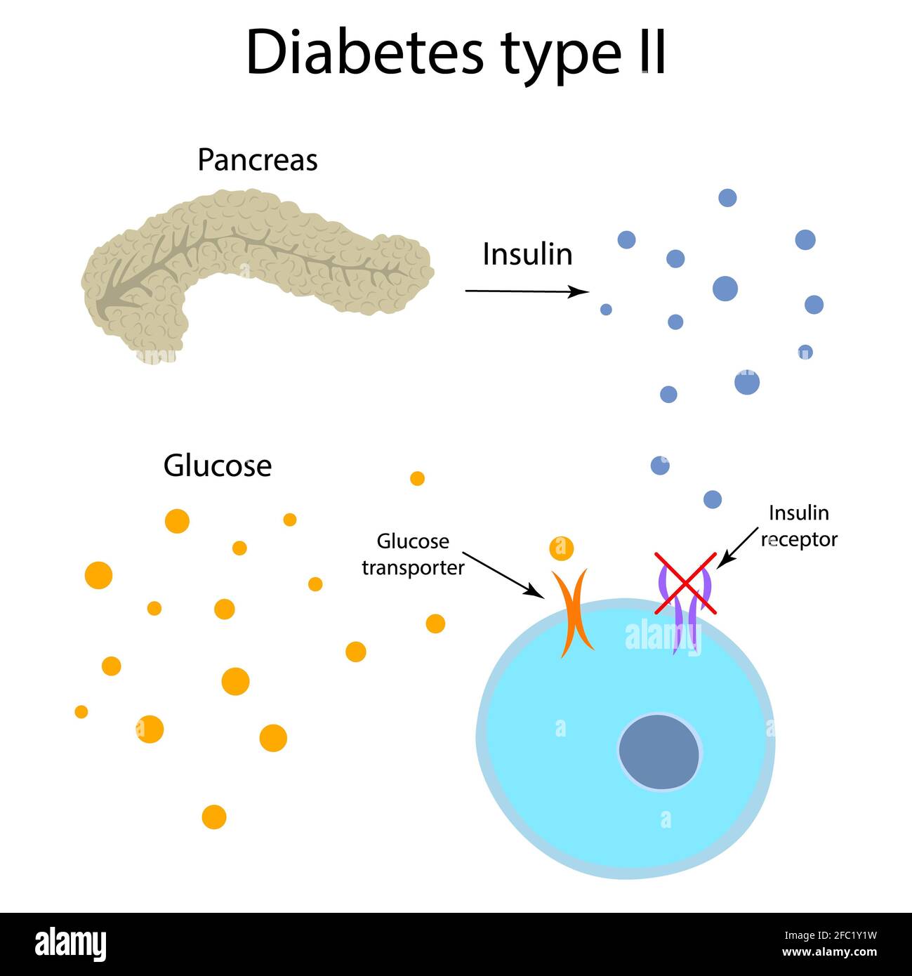 Diabete di tipo 2, illustrazione Foto Stock