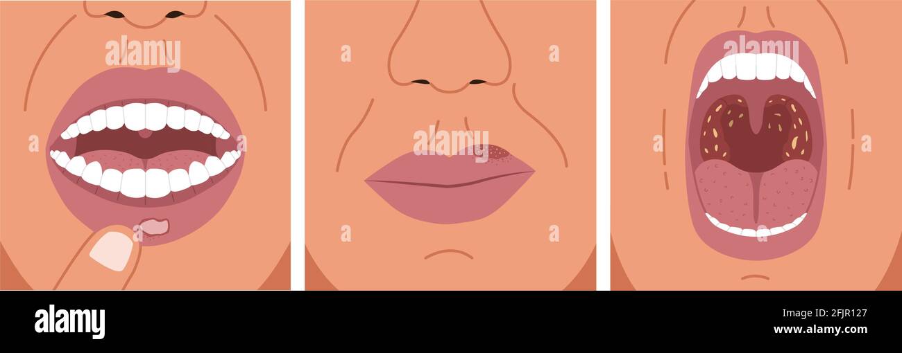 Il canker ha irritato, ha affannato freddo e ha irritato la gola. Illustrazione vettoriale di ulcera aftosa, herpes e tonsillite batterica. Illustrazione Vettoriale