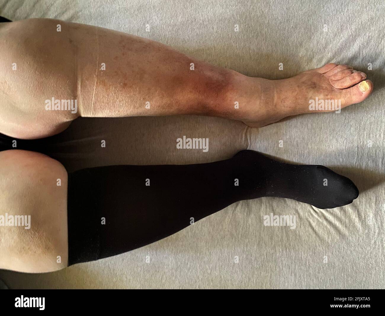 Donna indossa calze a compressione. Soffre di insufficienza venosa cronica con cellulite lieve alle gambe. Poggiare con la gamba rialzata Foto Stock