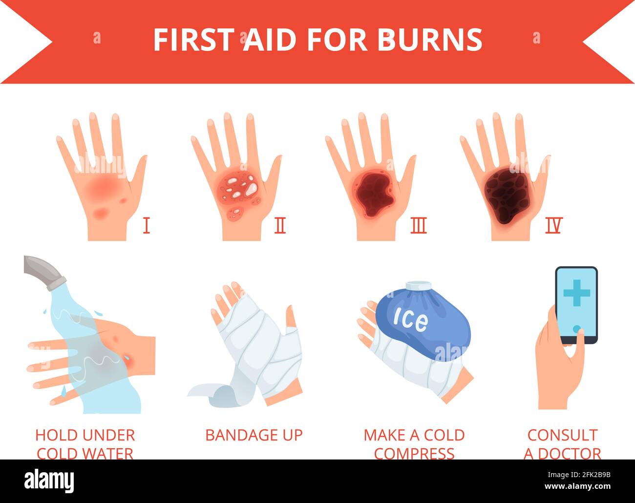 Bruciare la pelle. Primo trattamento fuoco della mano umana o distruzione chimica lesione graviera sicurezza della pelle per le persone infografiche vettoriali Illustrazione Vettoriale