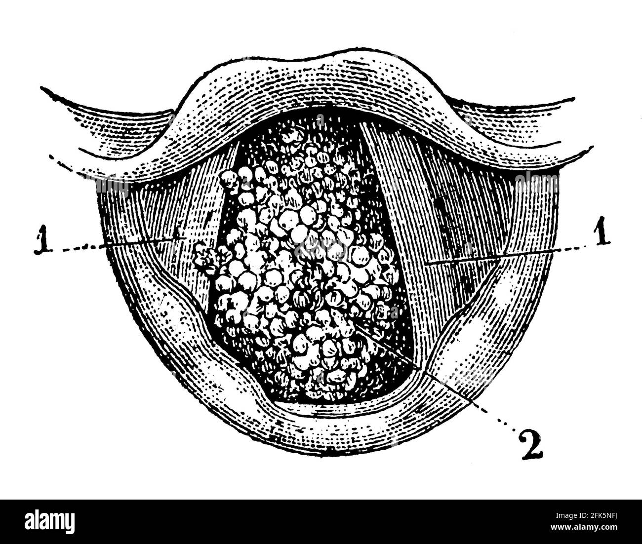 In basso sulla laringe. Corde vocali e villi polyp. Illustrazione del 19 ° secolo. Germania. Sfondo bianco. Foto Stock