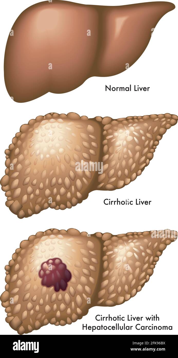 L'illustrazione medica confronta un fegato normale, con un fegato cirrotico e un fegato cirrotico con carcinoma epatocellulare, con annotazioni. Illustrazione Vettoriale