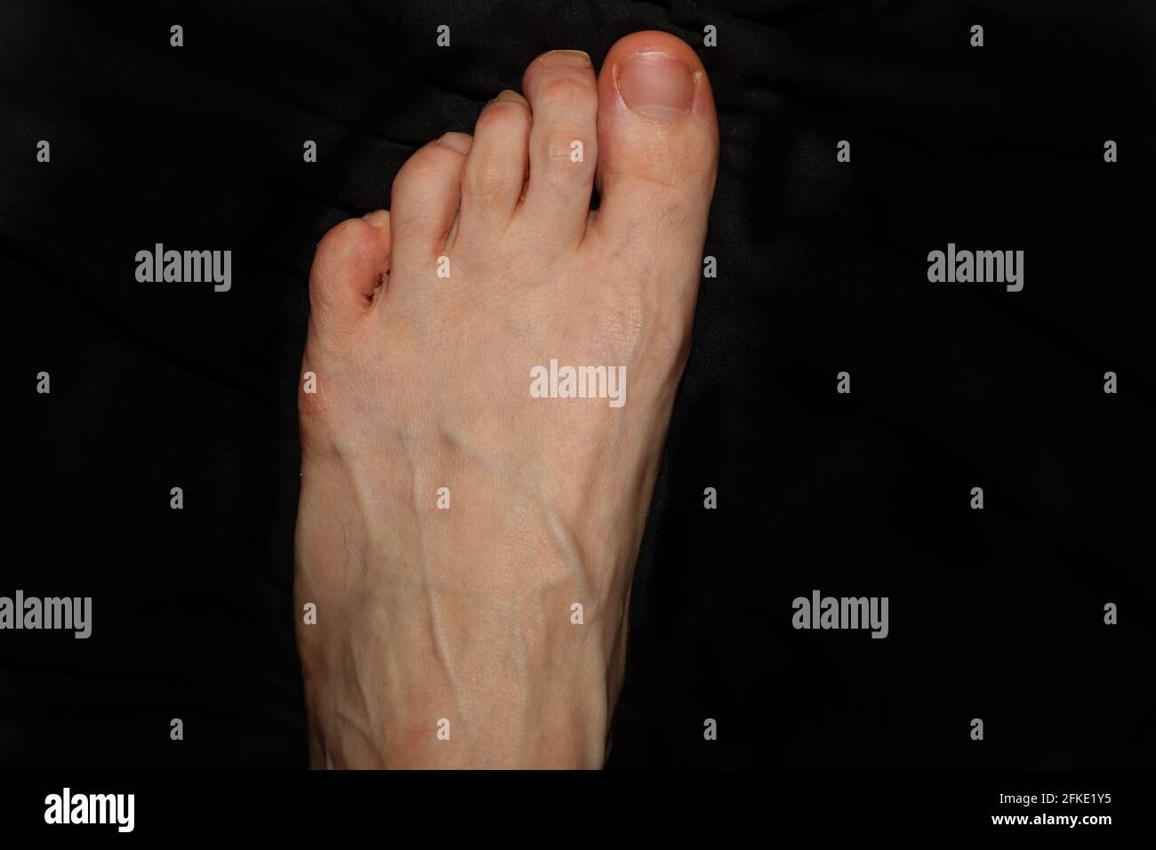 Dita dei piedi grasse e storte sul piede di una donna adulta Foto stock -  Alamy