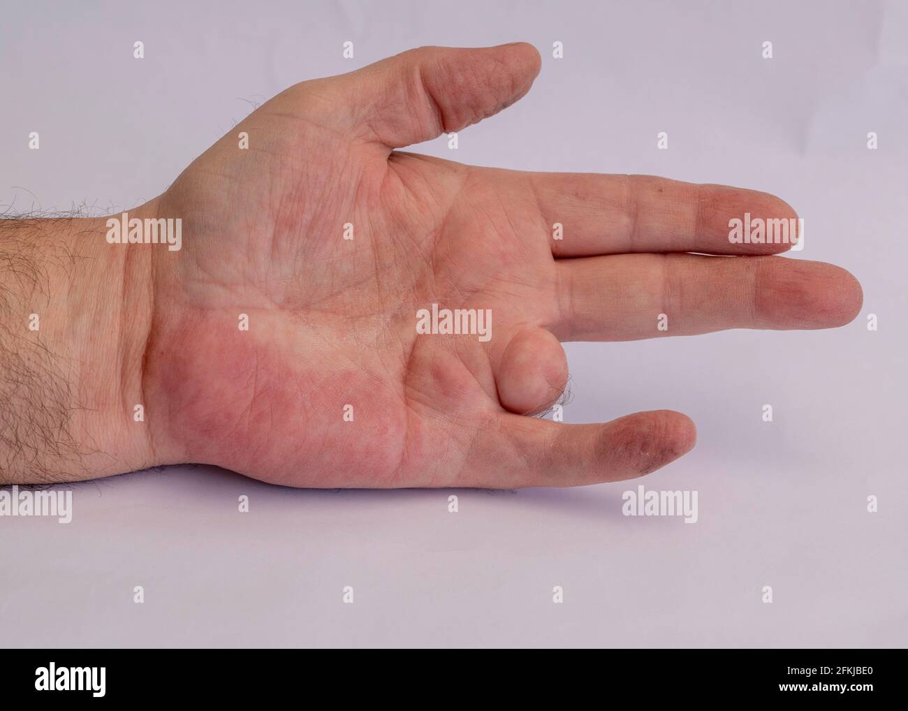 Mans mano sinistra dopo incidente con la ghiera rimossa dopo chirurgia Foto Stock