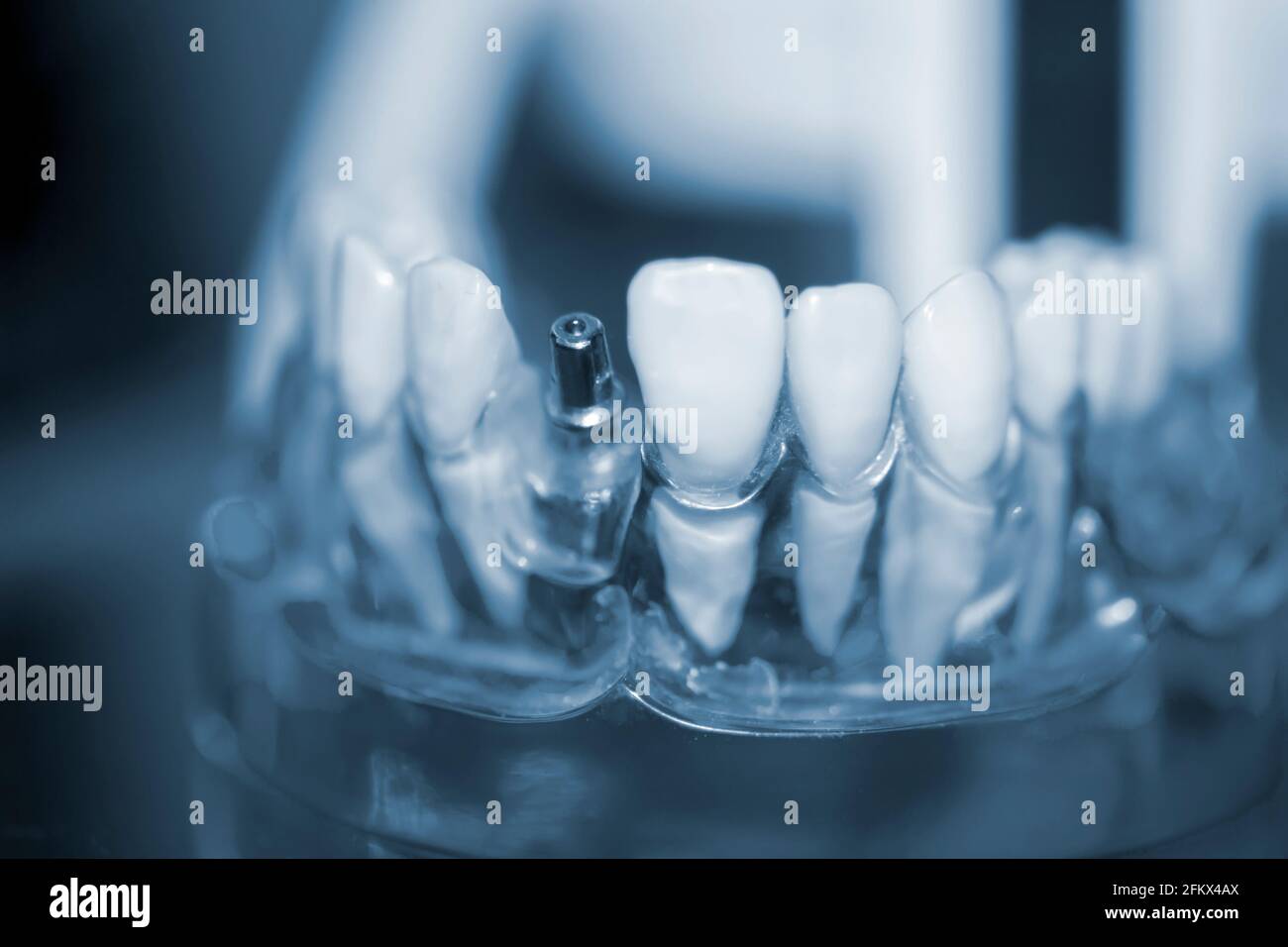 Modello trasparente di denti umani con impianti da primo piano. Foto Stock