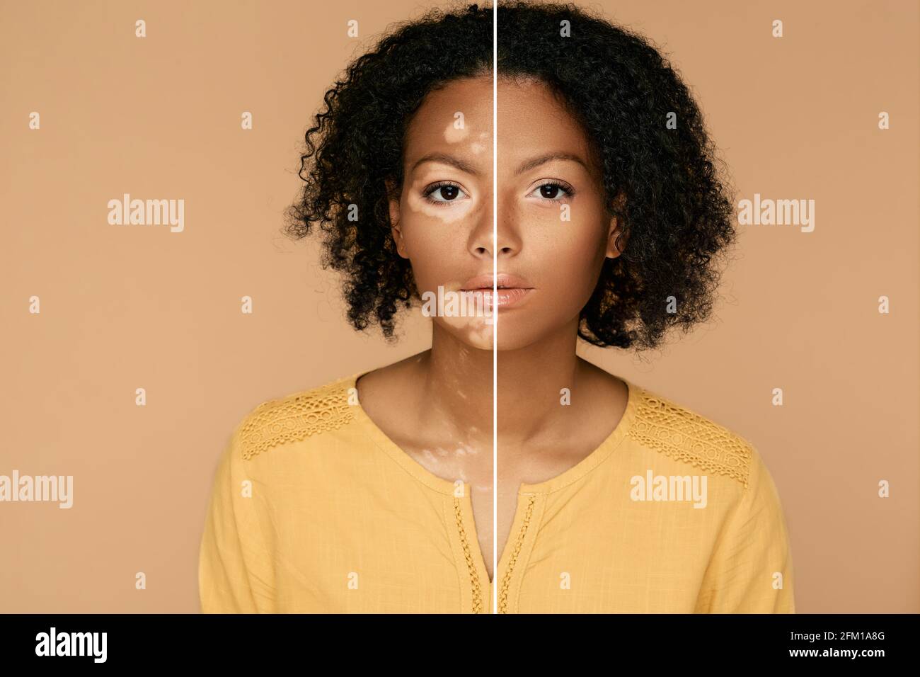 Confrontate il volto della donna con e senza vitiligine. Trattamento di pigmentazione della pelle di Vitiligo Foto Stock