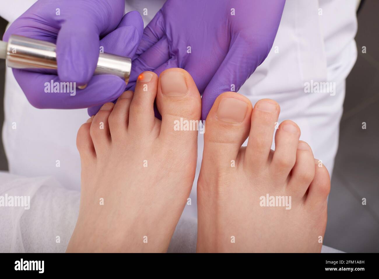 Trattamento laser di onicomicosi per la zootaglia del piede della donna, primo piano. Trattamento laser infezione fungina su toenail Foto Stock