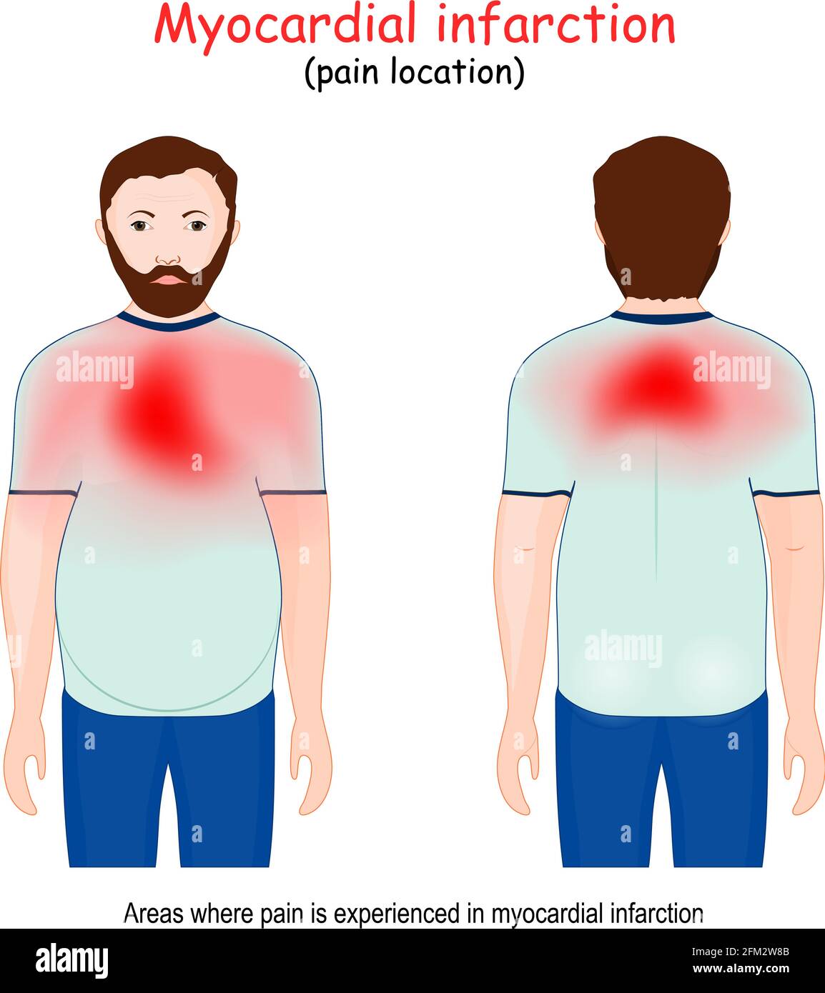 Aree di infarto miocardico. Attacco di cuore. Posizione del dolore. L'uomo e le zone sul petto e sulla schiena dove il dolore è avvertito nella malattia di cuore. Vettore Illustrazione Vettoriale