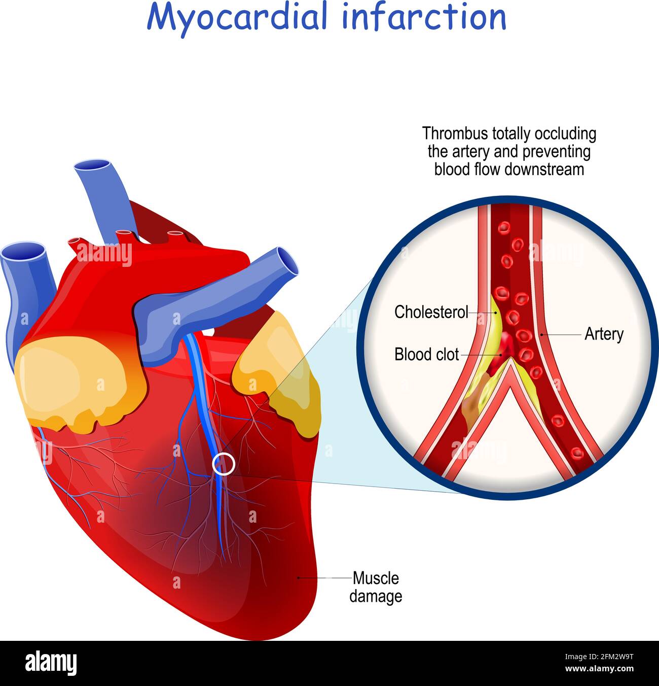 Infarto miocardico. Attacco cardiaco. Il trombo occlude completamente l'arteria e impedisce il flusso sanguigno a valle. Cuore con danni muscolari Illustrazione Vettoriale