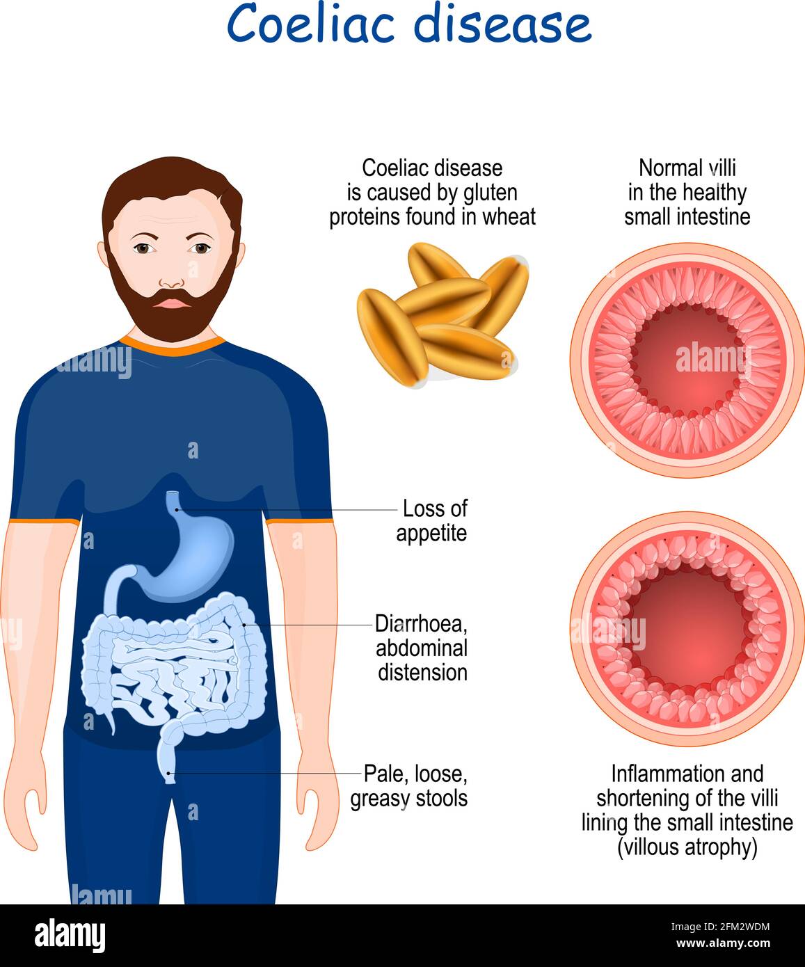 La celiachia è una malattia autoimmune che colpisce l'intestino tenue. Segni e sintomi della celiachia. Sezione trasversale dell'intestino tenue con NOR Illustrazione Vettoriale