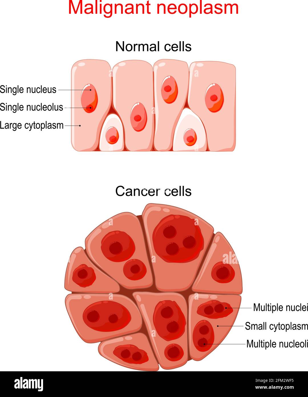 Neoplasia maligna. Cancro e cellule normali. Confronto e differenza tra tessuto sano e tumore. Dettagli su cromatina, nucleo Illustrazione Vettoriale