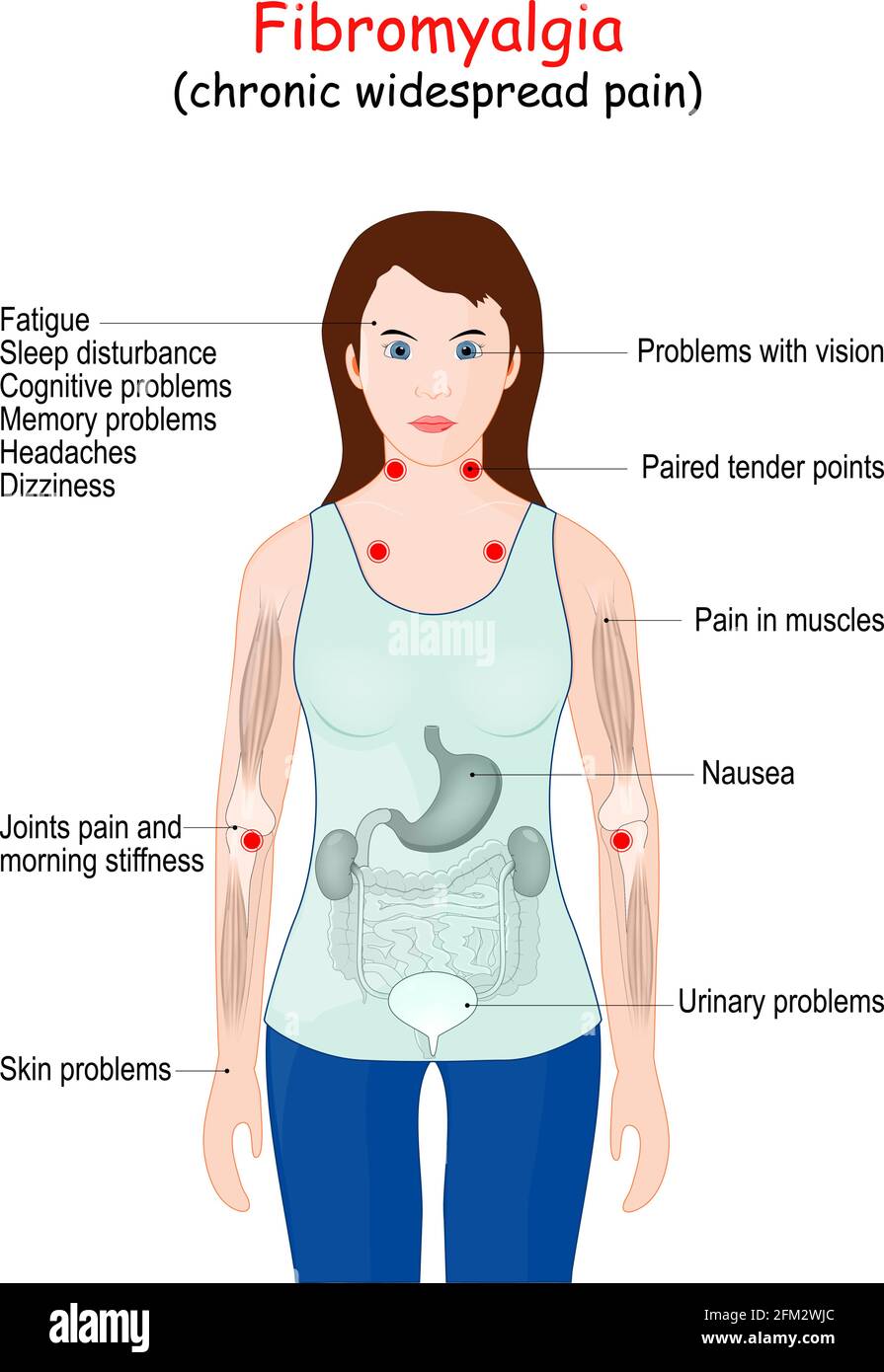 Fibromialgia (FM). Segni e sintomi della malattia. Silhouette donna con organi interni. Illustrazione vettoriale Illustrazione Vettoriale