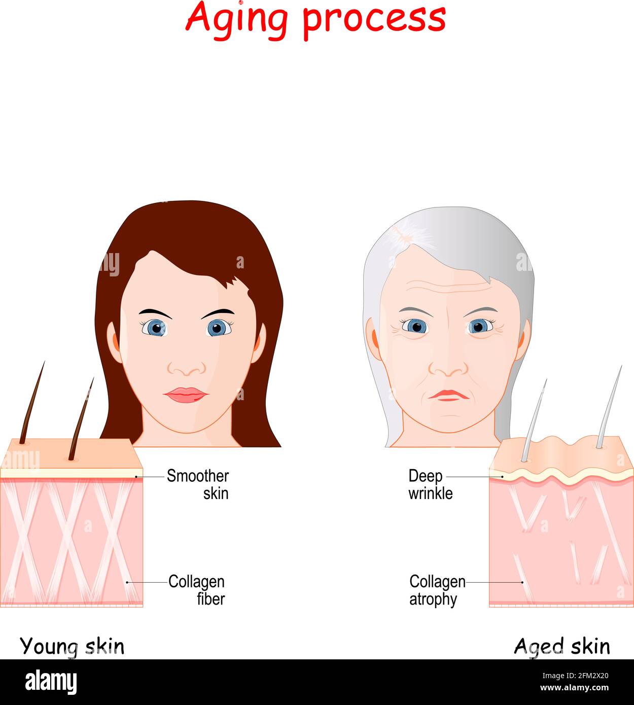 Confronto di processo di invecchiamento della pelle più giovane e più anziana. Pelle più liscia di ragazza con normali fibre di collagene e pelle di donna adulta con profonde rughe Illustrazione Vettoriale