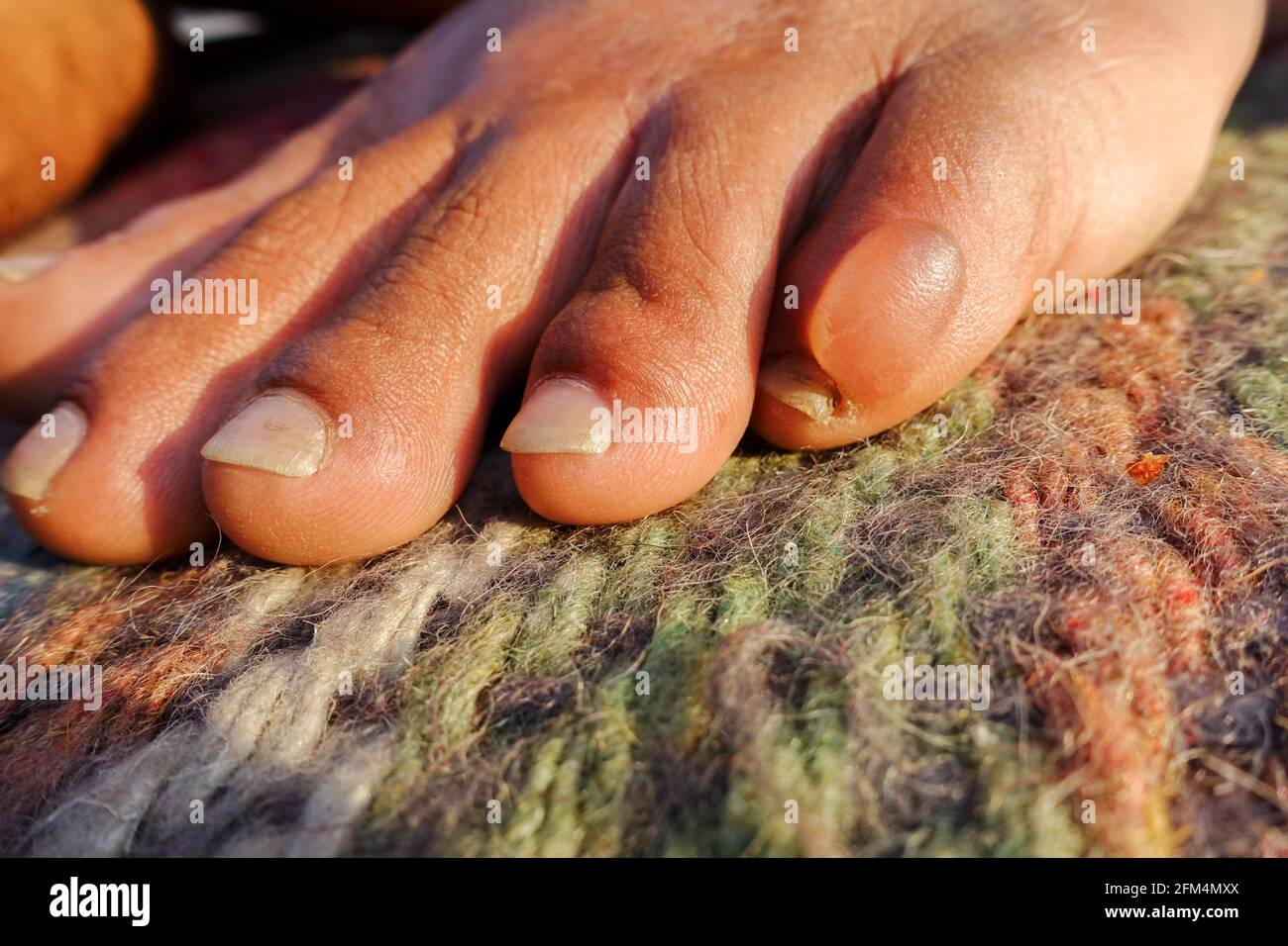 Un primo piano di un blister riempito d'acqua a piedi a causa di lunghe passeggiate. Un blister è una sacca di fluido tra gli strati superiori della pelle. Foto Stock