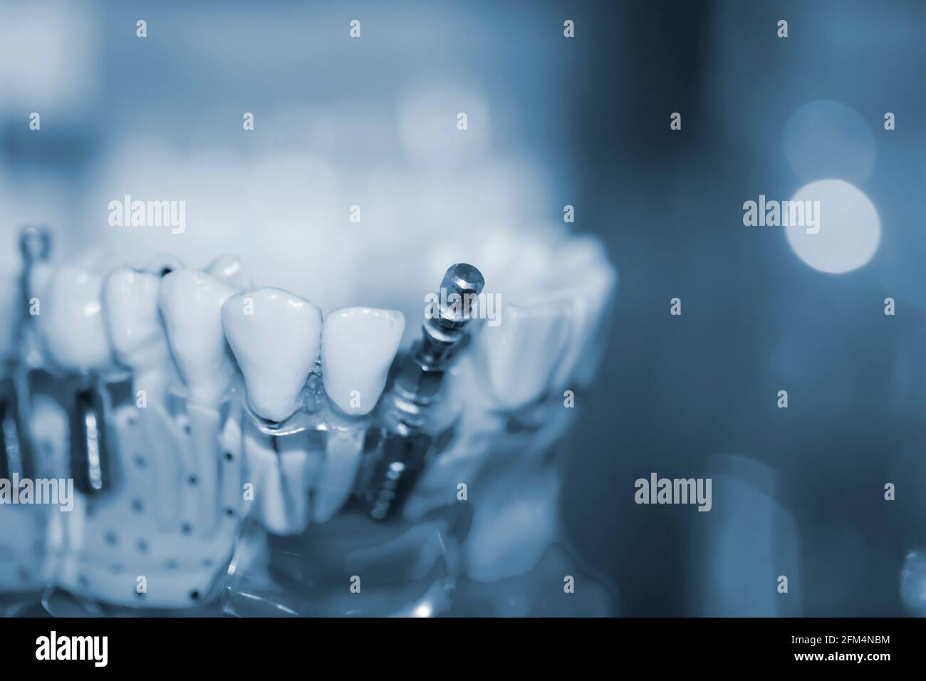 Modello trasparente di denti umani con impianti da primo piano. Foto Stock