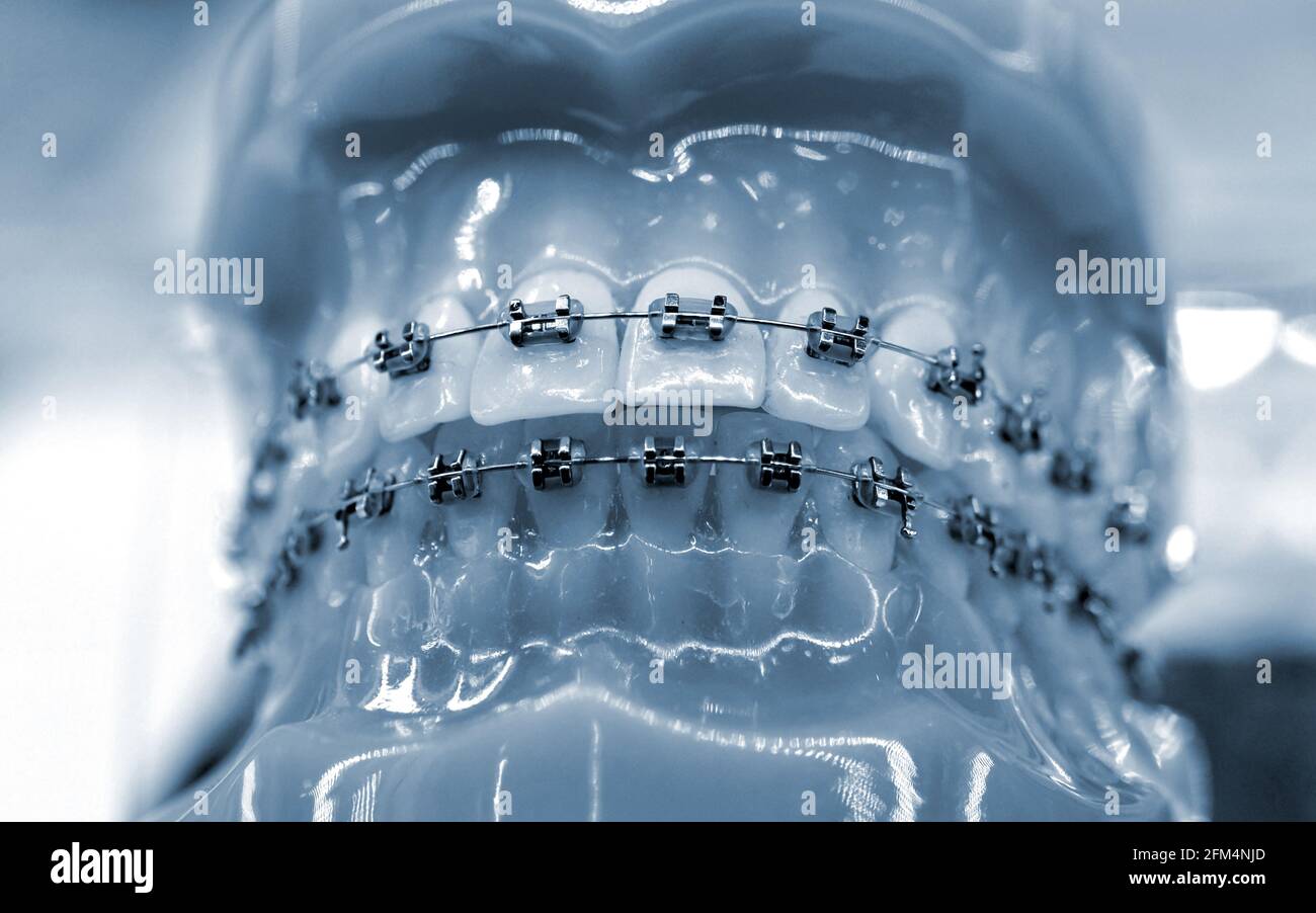 Parentesi graffe su un modello di denti umani, odontoiatria dentale primo piano. Foto Stock