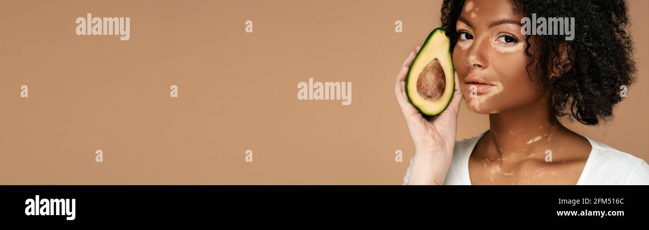 Donna con vitiligine tiene l'avocado vicino alla sua faccia macchiata. Idratante e cura della pelle pigmentata con l'utilizzo di cosmetici con avocado. Banner Web, orizzontale Foto Stock