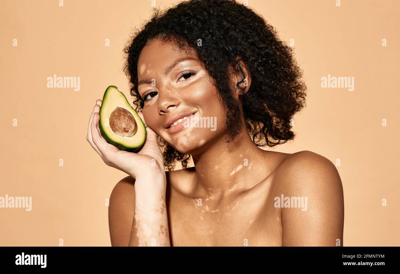 Donna afroamericana positiva con malattia di vitiligine tiene avocado vicino alla sua faccia. Cosmetici con avocado per la pelle pigmentata Foto Stock