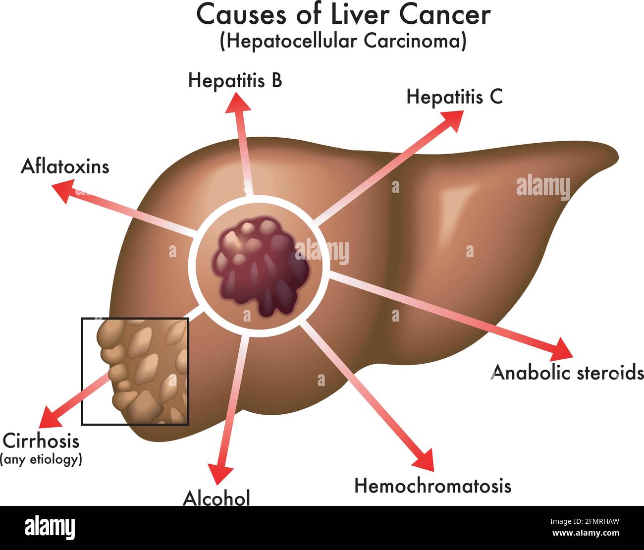 Illustrazione medica delle principali cause del cancro al fegato, con annotazioni, su sfondo bianco. Illustrazione Vettoriale