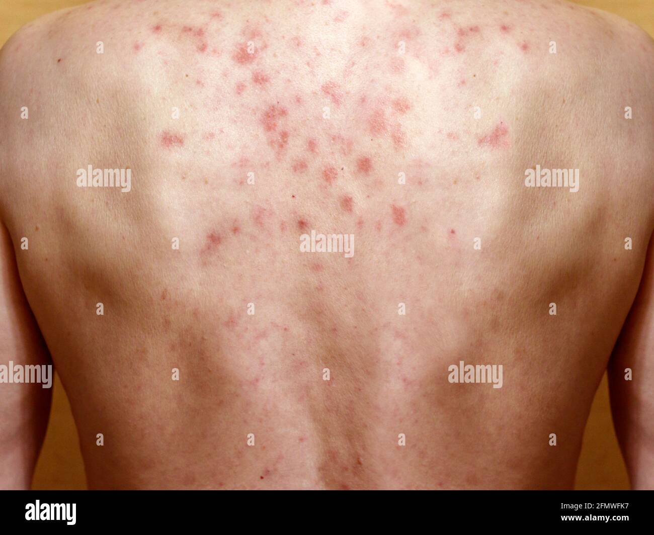 Dermatite Sulla Pelle Di Un Uomo S Schiena Reazione Allergica Eruzione Cutanea Allergica Sulla Cute Del Torace Dermatite Dermatite Seborroica Foto Stock Alamy
