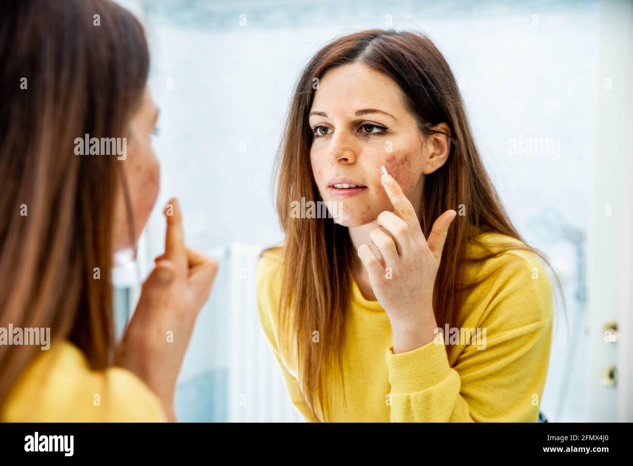 Giovane donna con problemi di pelle che applica crema di trattamento a casa - concetto di cura della pelle Foto Stock