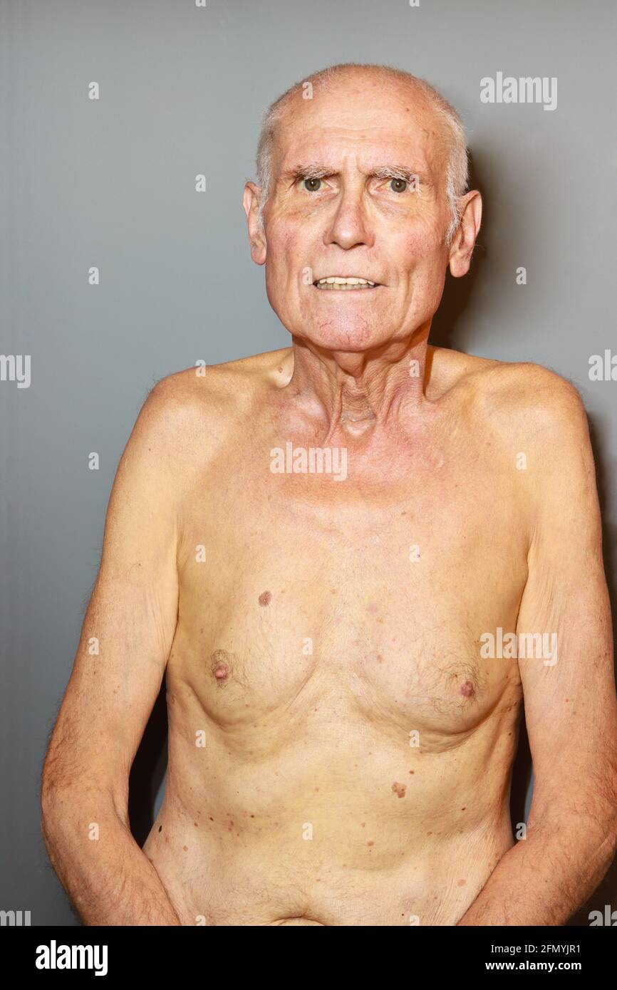 Uomo, guarigione con epatite autoimmune e miosite. Foto Stock