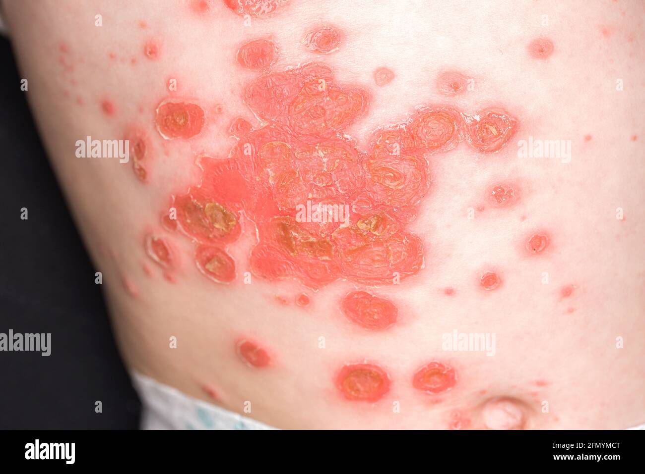 Pitiriasis Rosea è un tipo di dermatite con una lieve eruzione cutanea rosa  o rossa e un'eruzione cutanea traballante, placca materna Foto stock - Alamy