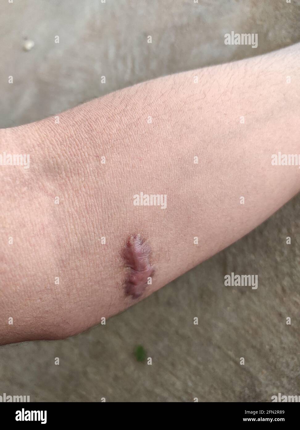 Primo piano della cicatrice keloide su un braccio maschio Foto Stock