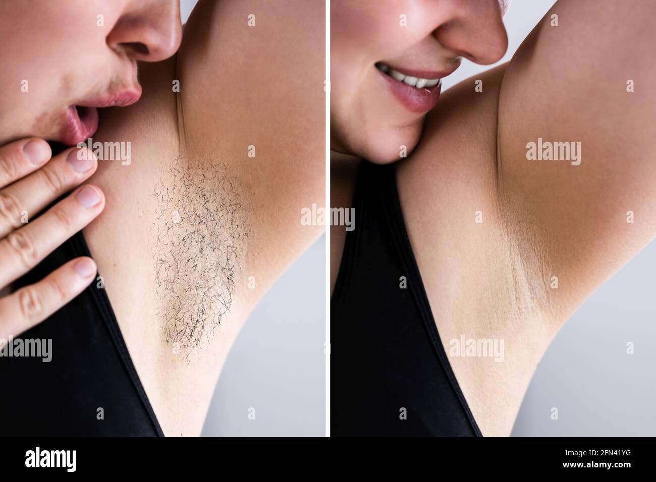 Prima di dopo la rimozione dei capelli del laser e IPL Foto stock - Alamy