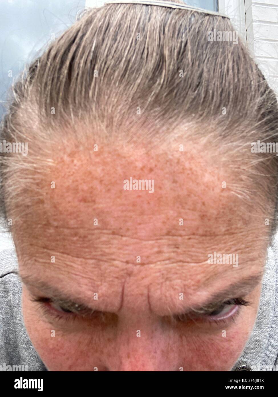 melasma lentigo sulla pelle di una macro foto uomo. Pigmentazione cutanea melasma iperpigmentazione con età, macchie di pigmento, invecchiamento della pelle Foto Stock